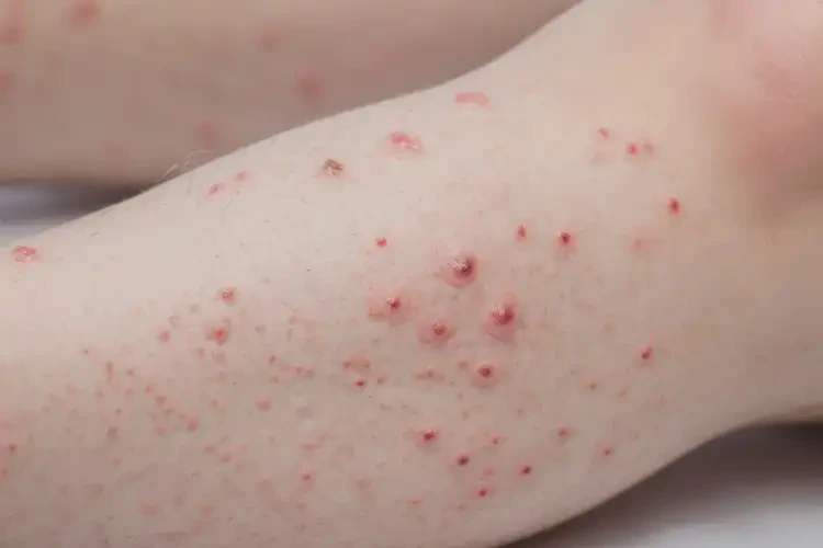 兒童小腿上容易起濕疹可以徹底自愈嗎(圖4)