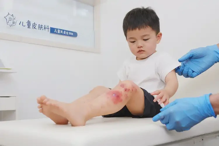 孩子大腿上经常起湿疹能彻底自愈吗(图4)