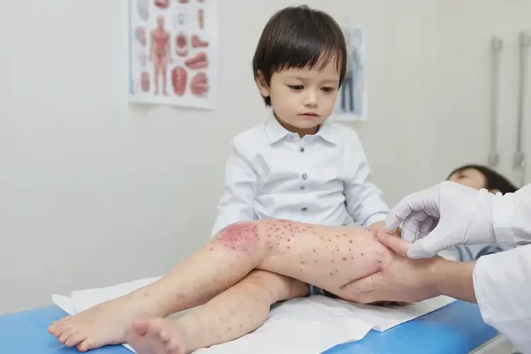 兒童大腿上出濕疹可以徹底自愈嗎(圖4)