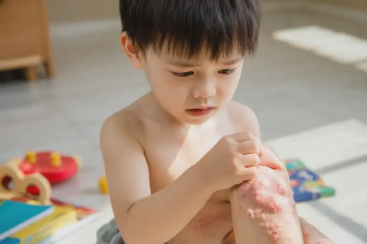 少兒大腿上出現(xiàn)濕疹不管它會(huì)自己好嗎(圖4)