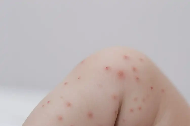 嬰幼兒小腿出現(xiàn)濕疹不管它會自己痊愈嗎(圖3)