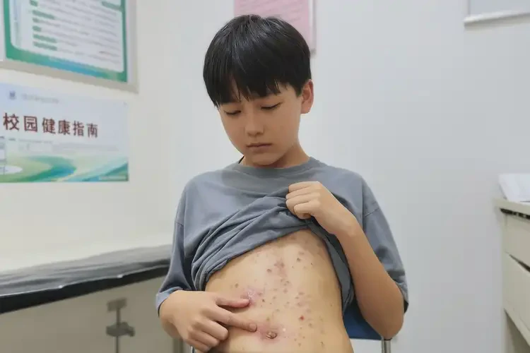 大学生肚子上容易起湿疹可不可以彻底自愈(图4)