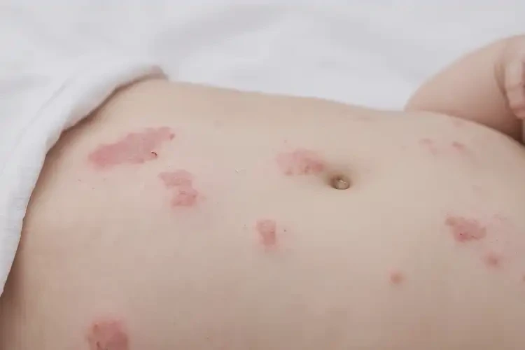 嬰幼兒肚子上偶爾起濕疹能徹底自愈嗎(圖4)