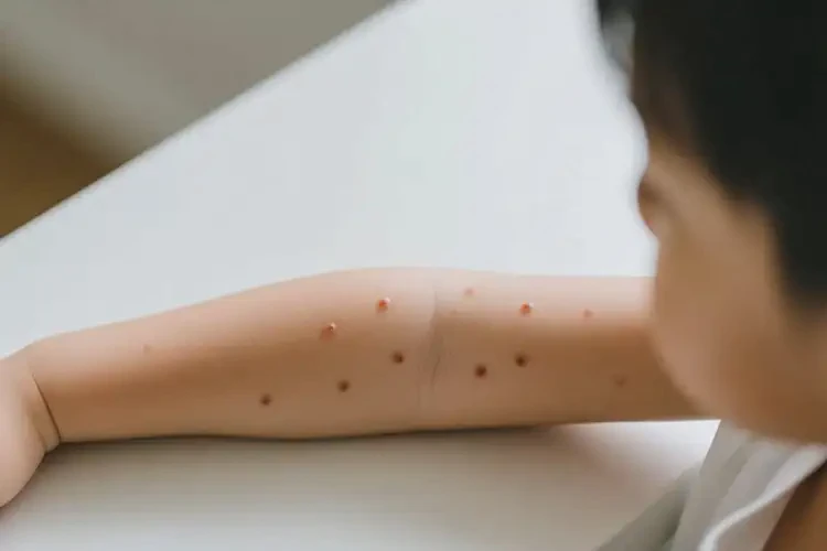 孩子手臂偶爾長濕疹不管它會自己好嗎(圖2)