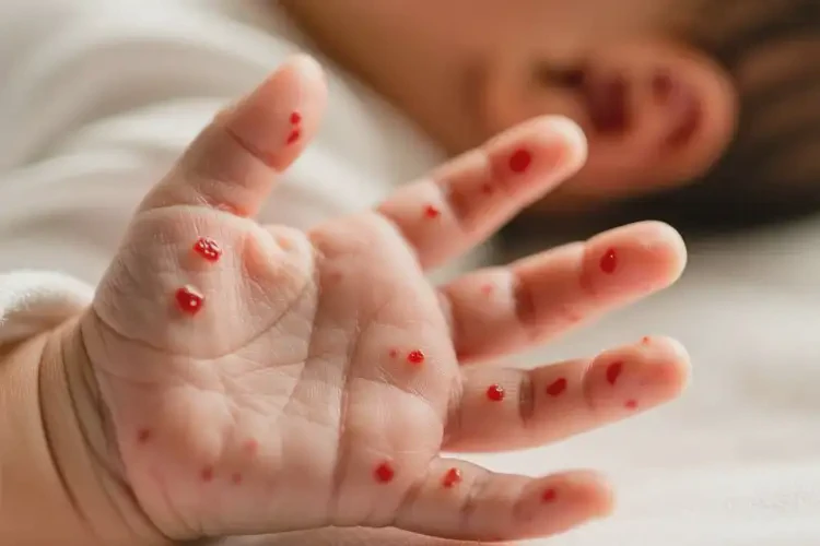 新生兒手上長濕疹能靠自己自愈嗎(圖1)