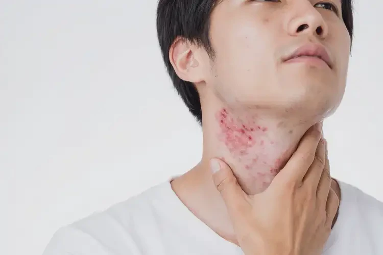 青年人脖子容易長濕疹不管它會自己好嗎(圖4)