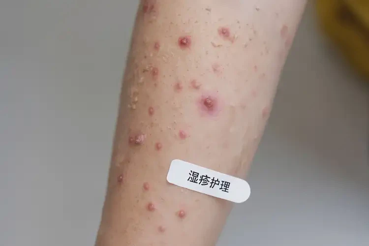 小學(xué)生手臂起濕疹能夠徹底治愈嗎(圖4)
