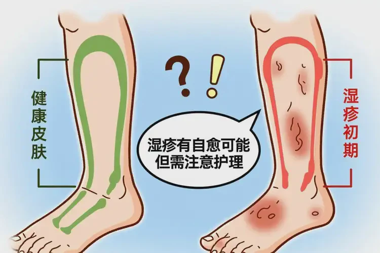 老人小腿上容易長(zhǎng)濕疹能靠自己自愈嗎(圖2)
