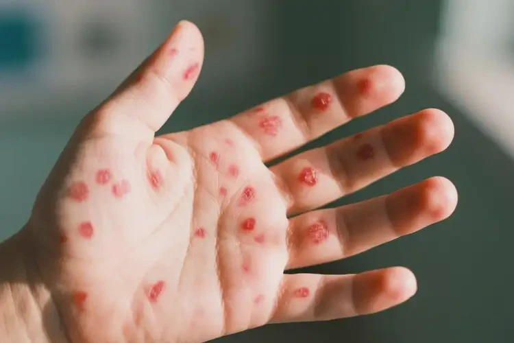 小孩手上出現(xiàn)濕疹不管它會自己好嗎(圖4)