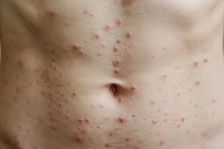 青少年肚子上偶尔长湿疹可不可以彻底自愈(图4)