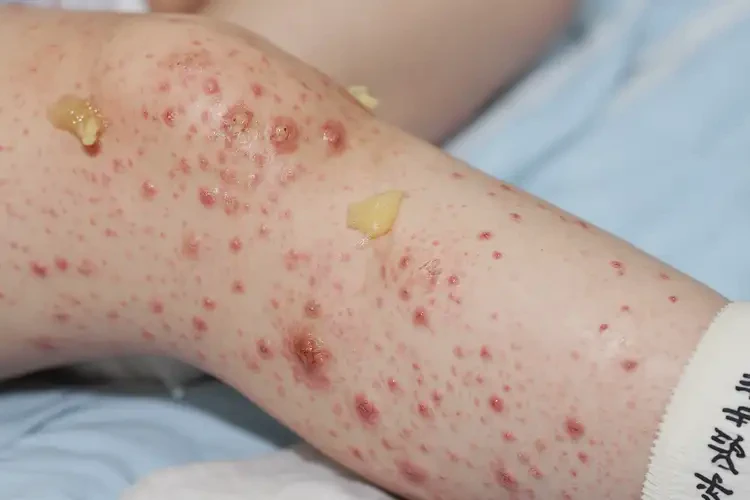 小孩小腿上有濕疹不管它會自己好嗎(圖2)