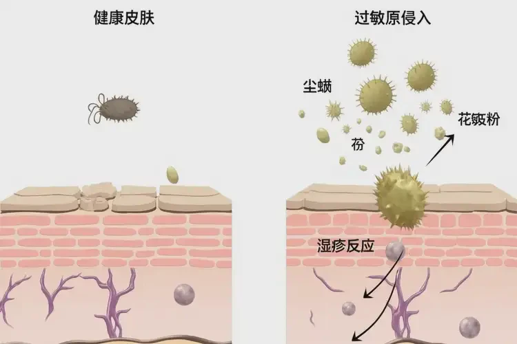 小學(xué)生四肢偶爾起濕疹不管它會(huì)自己痊愈嗎(圖3)