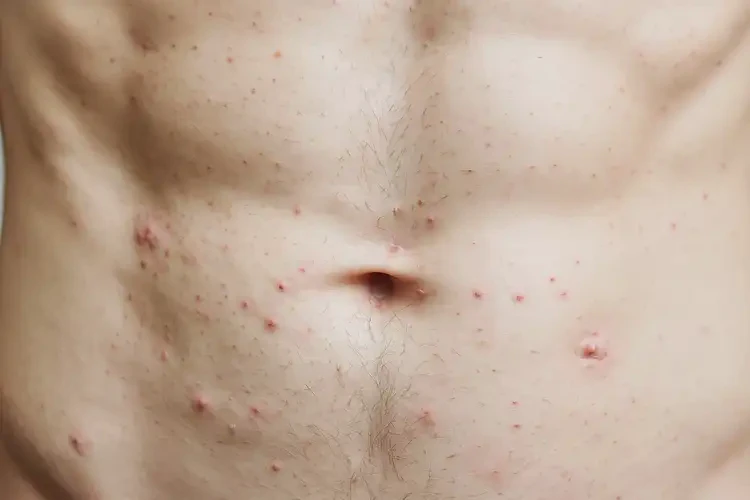 男生肚子上偶爾長(zhǎng)濕疹能夠徹底治愈嗎(圖4)