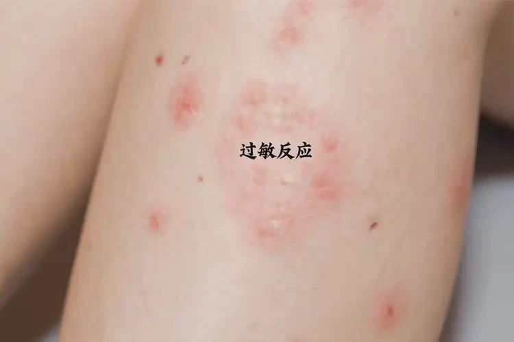 女生大腿經(jīng)常起濕疹能夠徹底治愈嗎(圖4)