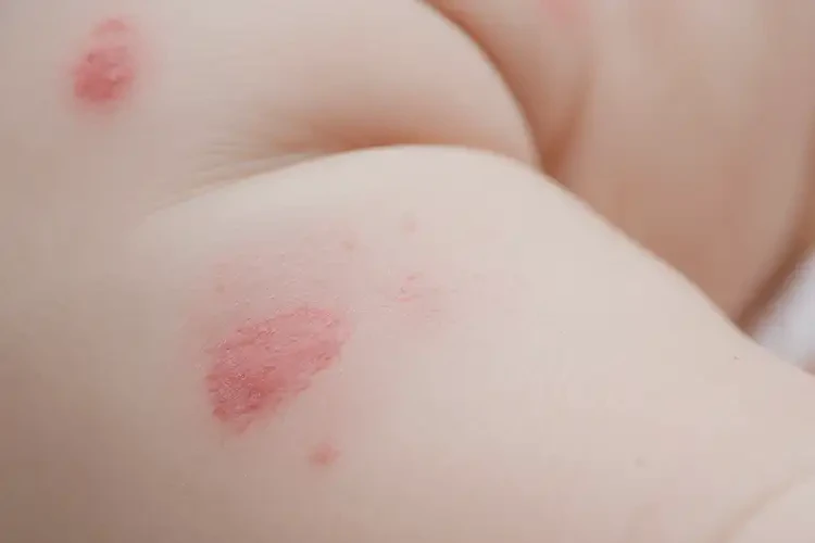 嬰兒屁股經(jīng)常長(zhǎng)濕疹能夠徹底治愈嗎(圖4)