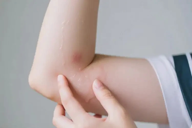 大學(xué)生手臂上偶爾起濕疹可不可以徹底自愈(圖3)