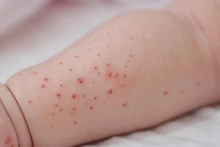 新生兒手臂容易起濕疹可不可以徹底自愈(圖4)