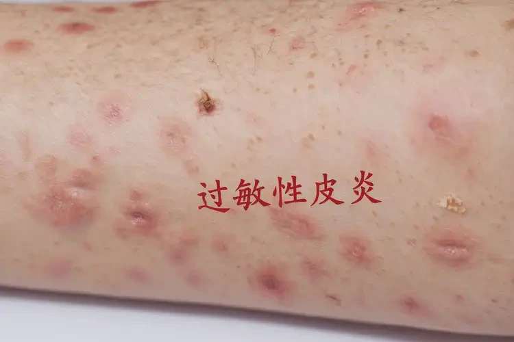 女人手臂出濕疹可不可以徹底自愈(圖3)