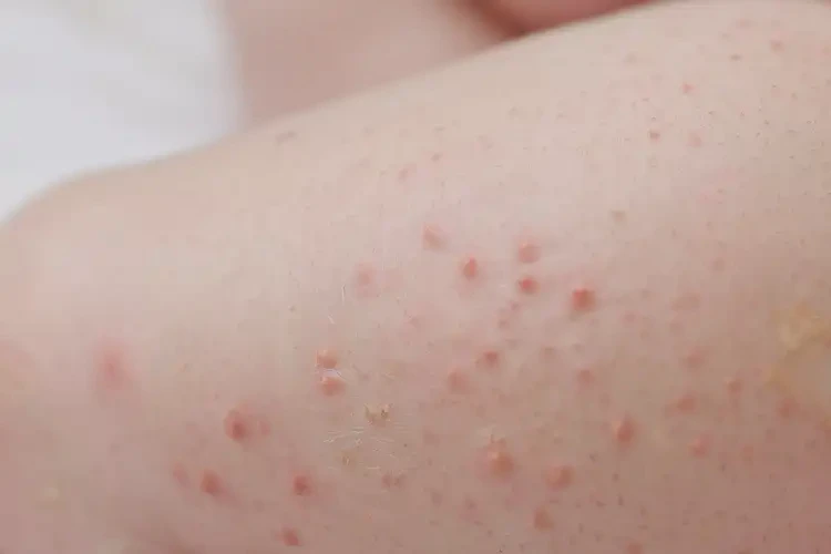 新生兒大腿出現(xiàn)濕疹可不可以徹底自愈(圖4)