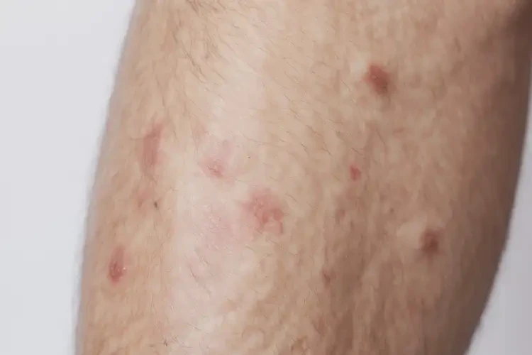 男人大腿容易起濕疹能徹底自愈嗎(圖4)