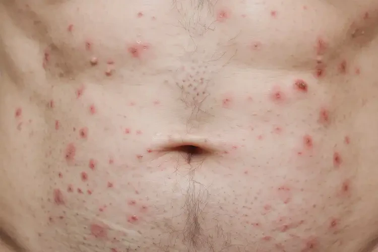 男人肚子容易起濕疹不管它會(huì)自己好嗎(圖4)