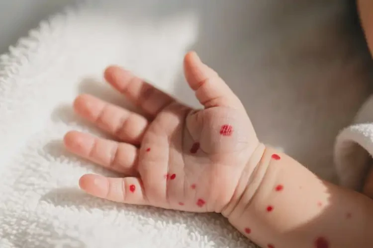 新生兒手上長濕疹能靠自己自愈嗎(圖3)