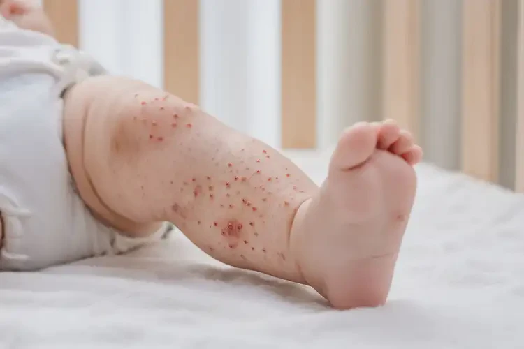 孩子大腿上偶爾起濕疹不管它會自己好嗎(圖3)