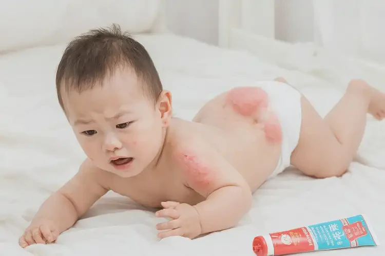 嬰幼兒屁股起濕疹能靠自己自愈嗎(圖4)