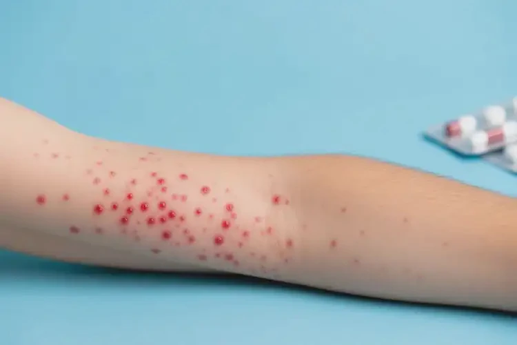 青年人手臂上偶爾起濕疹不管它會自己好嗎(圖1)