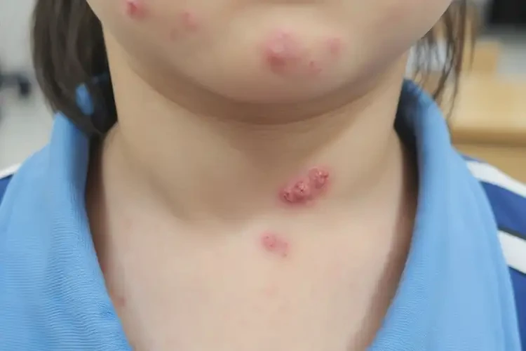 小學(xué)生脖子容易長濕疹能靠自己自愈嗎(圖4)