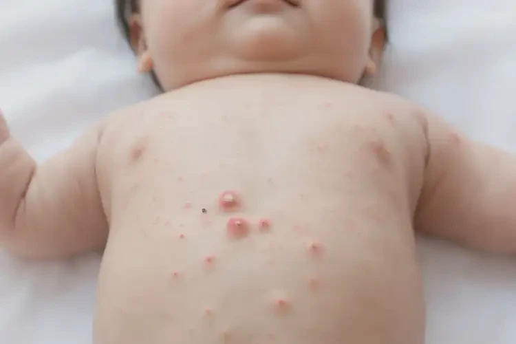 嬰兒肚子上有濕疹能靠自己自愈嗎(圖4)