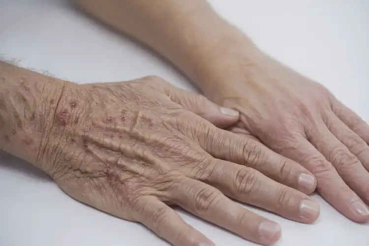 老人臉上有濕疹可以徹底自愈嗎(圖3)