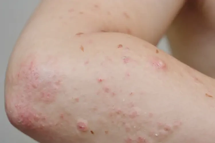 小學(xué)生四肢出現(xiàn)濕疹能徹底自愈嗎(圖4)