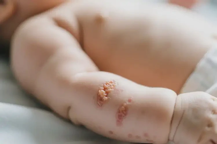 寶寶全身出濕疹不管它會(huì)自己痊愈嗎(圖3)