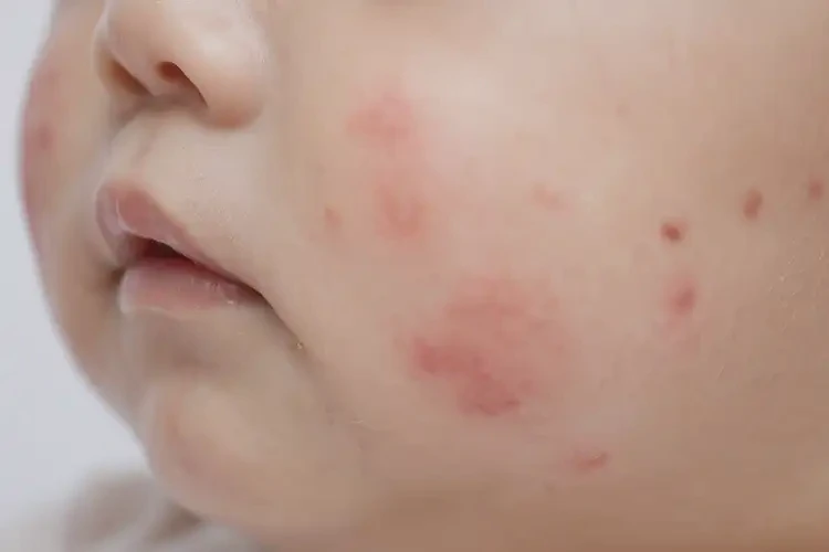 寶寶屁股上容易長(zhǎng)濕疹不管它會(huì)自己痊愈嗎(圖4)