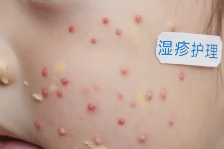 小孩臉上經(jīng)常長濕疹不管它會自己痊愈嗎(圖4)