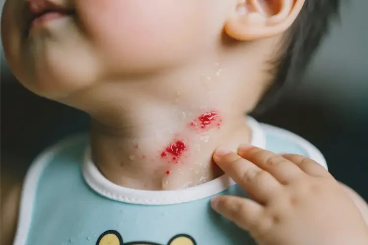 孩子脖子上出現(xiàn)濕疹不管它會(huì)自己好嗎(圖2)