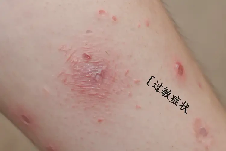 兒童手臂有濕疹能靠自己自愈嗎(圖4)