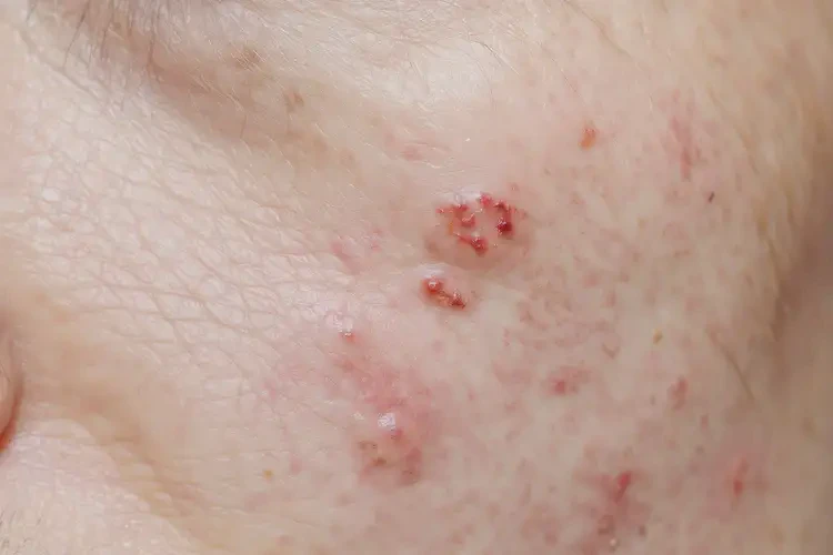 男生肛周起濕疹不管它會(huì)自己自愈嗎(圖4)