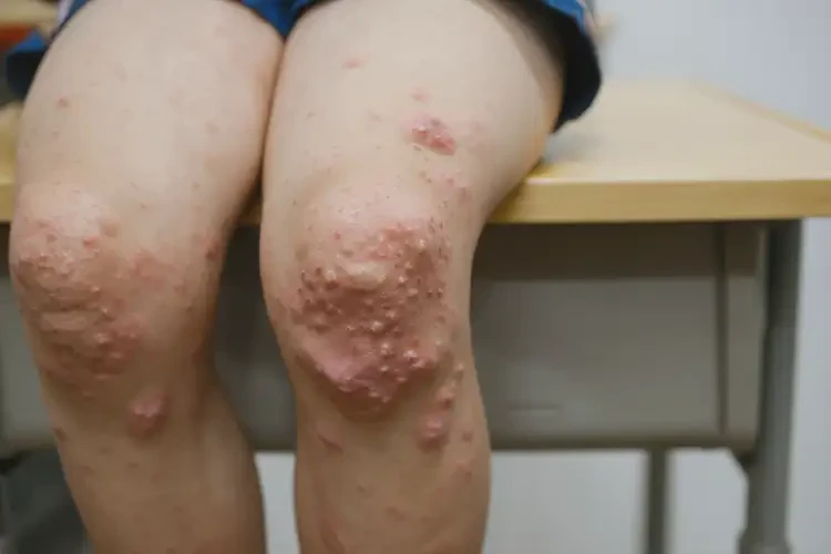 小学生大腿上起湿疹不管它会自己好吗(图4)