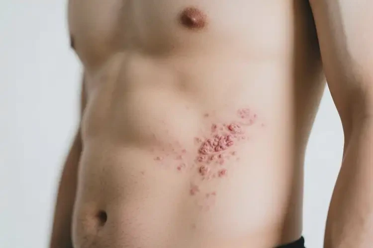 男人肚子上容易起濕疹能徹底自愈嗎(圖3)