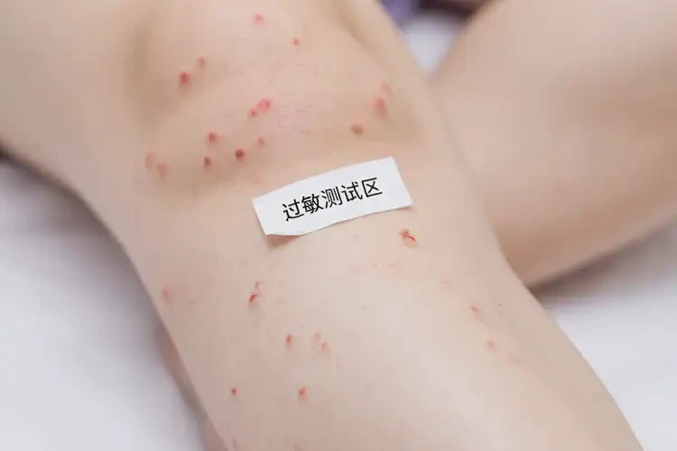 孩子大腿上经常起湿疹可以彻底自愈吗(图4)
