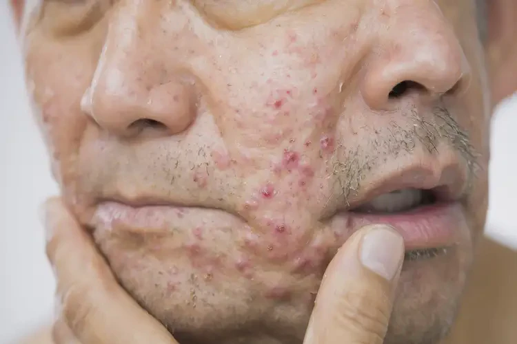 男性面部經(jīng)常長(zhǎng)濕疹能夠徹底治愈嗎(圖4)