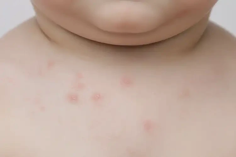 幼兒脖子上偶爾起濕疹不管它會(huì)自己痊愈嗎(圖4)