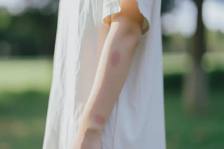 女生手臂上容易长湿疹能靠自己自愈吗(图2)