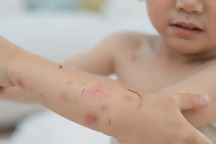 小孩身上容易起濕疹不管它會(huì)自己自愈嗎(圖4)