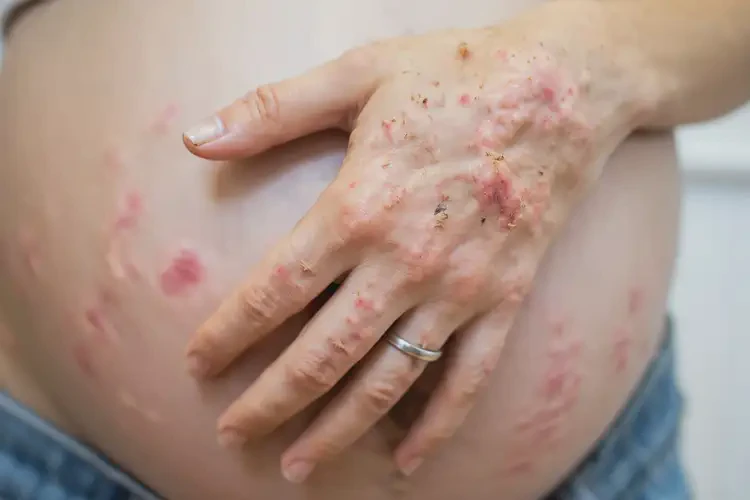 孕婦手上偶爾起濕疹能夠徹底治愈嗎(圖4)