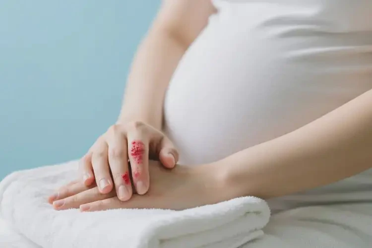 孕婦手上容易起濕疹不管它會自己痊愈嗎(圖2)