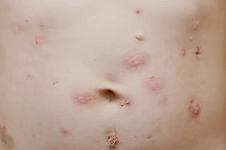 孩子肚子出現(xiàn)濕疹可以徹底自愈嗎(圖4)