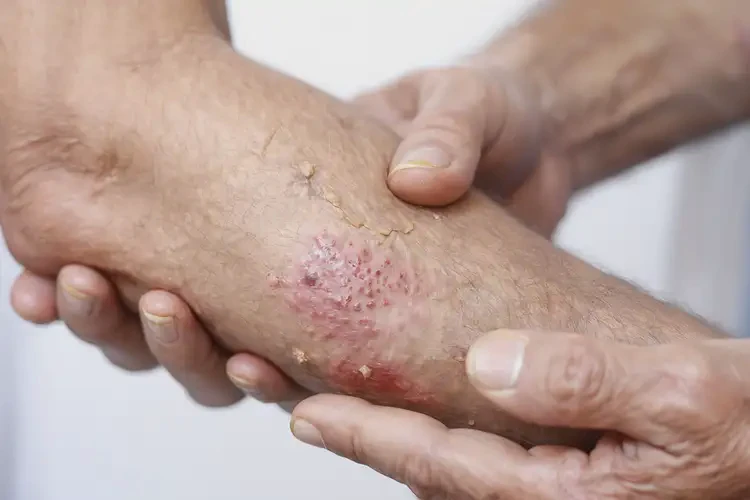 老年人手臂上容易起濕疹能徹底自愈嗎(圖4)